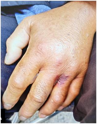 Vibrio vulnificus infection from insect bites in Shanghai: a case report